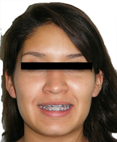 Fig. 12 Sonrisa