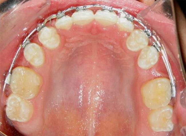 Fig. 16 Oclusal superior progreso