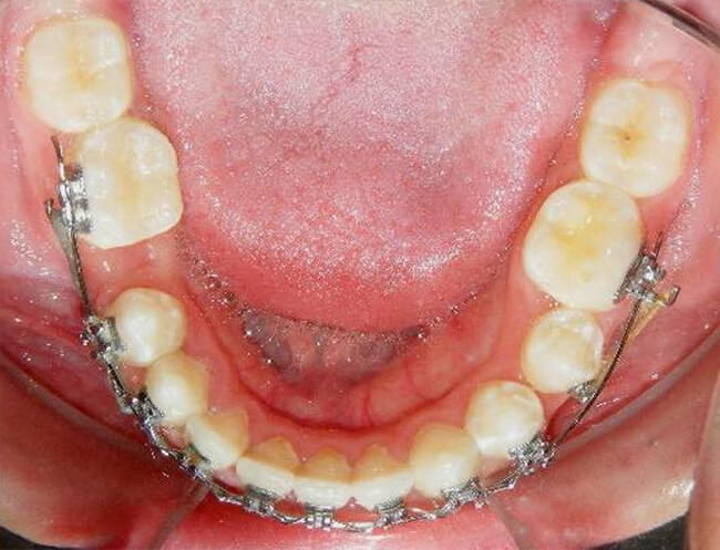 Fig. 17 Oclusal inferior progreso
