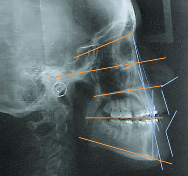 Fig. 18 Rx lateral de cráneo progreso trazado cefalométrico