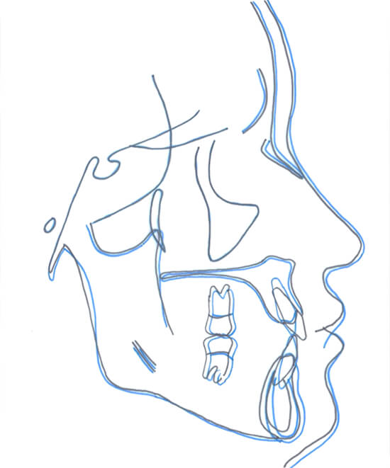 Fig. 20 Sobreimposición componente craneofacial