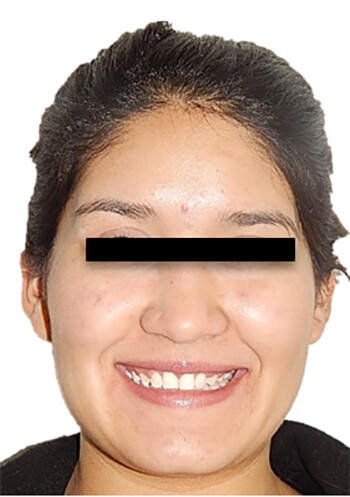 Fig. 23 Sonrisa final