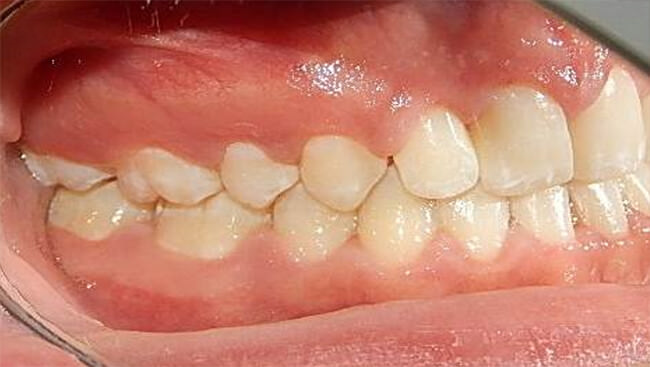 Fig. 25 Lateral derecha final