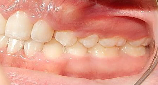 Fig. 26 Lateral izquierda final
