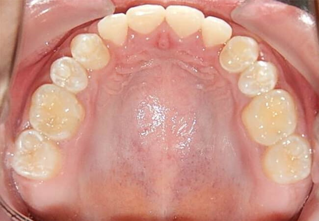Fig. 27 Oclusal superior final