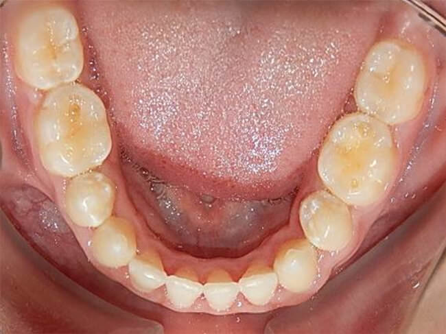 Fig. 28 Oclusal inferior