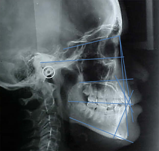 Fig. 29 Rx lateral de cráneo comparativas