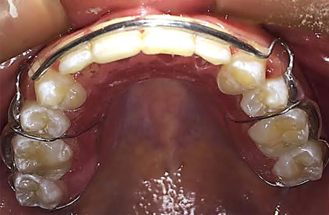 Fig.31 Retenedor circunferencial superior