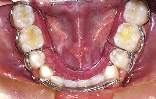Fig. 32 Retenedor inferior