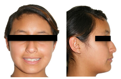 Fig. 1 Extraoral sonrisa y perfil