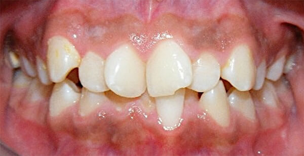 Fig. 2 Intraoral de frente