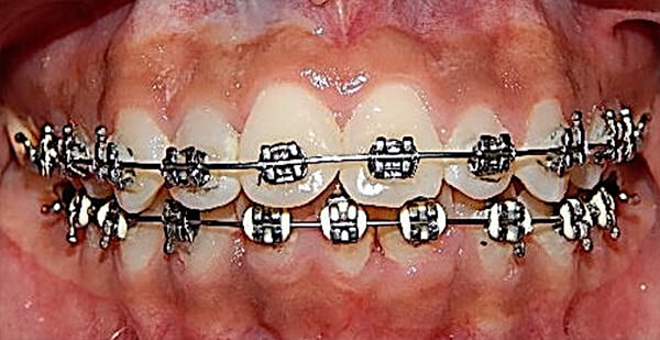 Fig. 8 Intraoral de frente