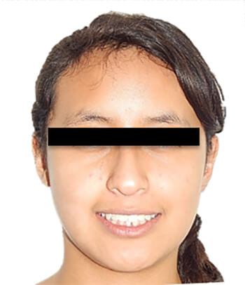 Fig. 9 Extraoral de frente de sonrisa