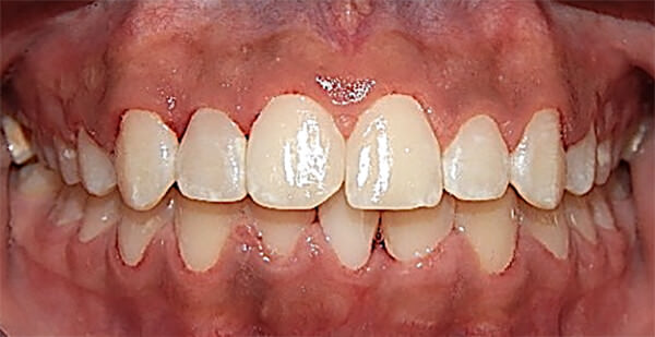 Fig. 11 Intraoral de frente
