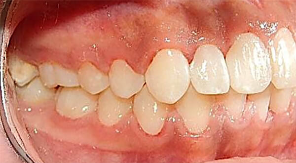 Fig. 12 Intraoral lateral derecha