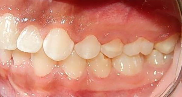 Fig.13 Intraoral lateral izquierda