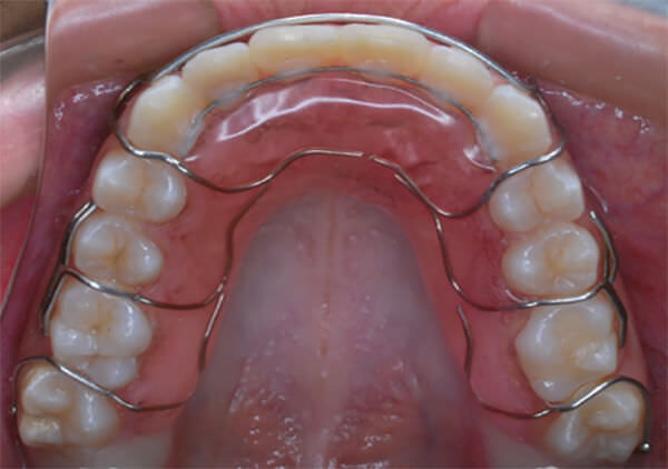 Fig. 14 Vista oclusal del Hawley superior con fijo de canino a canino