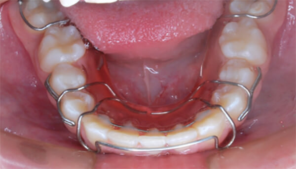Fig. 15 Vista oclusal de Hawley inferior con fijo de canino a canino