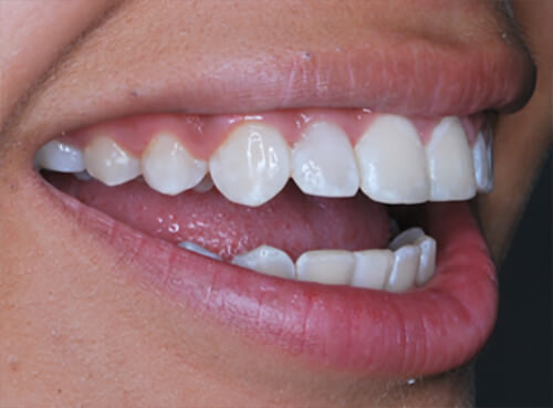 Fig. 17 Vista de bordes incisales