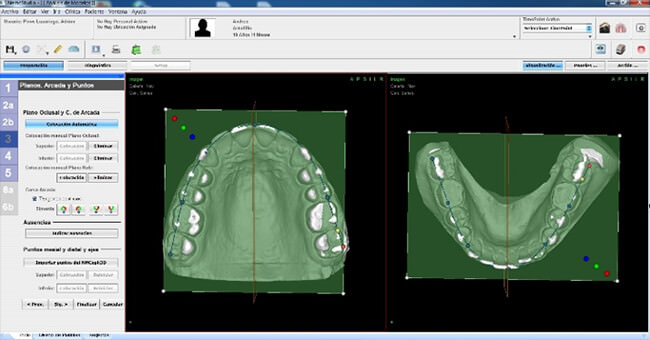 Figura 5 Colocación de plano oclusal y rafe medio
