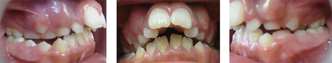 Figura 3 Fotografías iniciales intraorales mostrando la clase II División 1, subdivisión, muy leve izquierda, mordida cruzada posterior parcial de ambos lados la severa protrusión dental anterior.