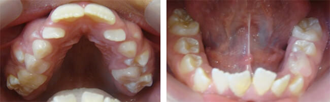 Figura 4 Fotografías iniciales intraorales mostrando paladar triangular estrecho e irregular arcada inferior más amplia que maxilar y dientes desalineados superiores e inferiores. Fuente: Fotografías Dra. Margarita Ponce,