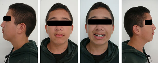Figura 5 Fotografías extra orales de avance, evidenciando un mejor equilibrio facial tanto frontal como de perfil facial.