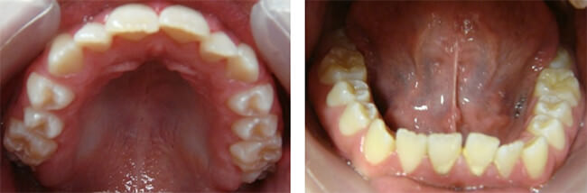 Figura 7 Fotografías oclusales evidenciando la forma oval de las arcadas dentarias y aun con inclinación dentaria anterior pero ya disminuida. Fuente: Fotografías de la Dra. Margarita Ponce.