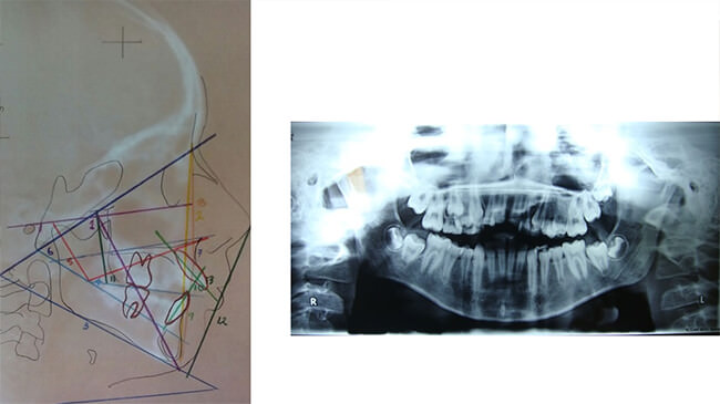 Figura 8 Radiografías iniciales, Perfil lateral (Con trazos cefalometricos siguiendo pautas de Ricketts), radiografía panorámica. Fuente: propia