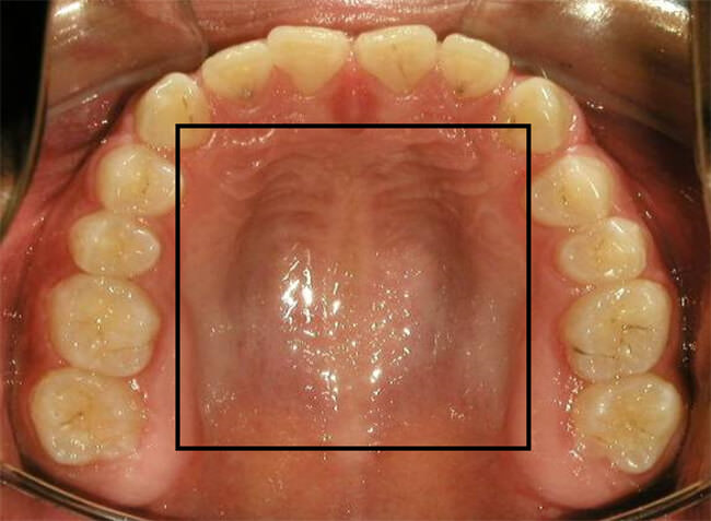 Figura. 7 Oclusal superior