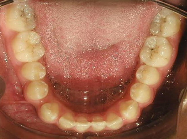 Figura. 8 Oclusal inferior