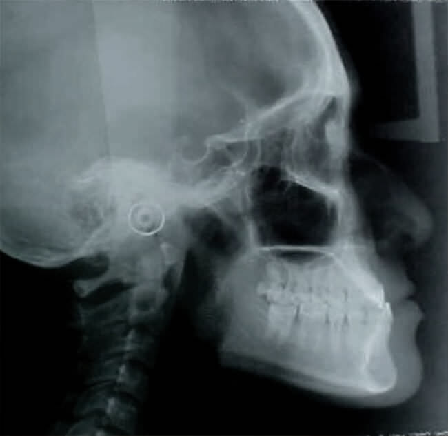 Fig. 9 Rx cefálica lateral