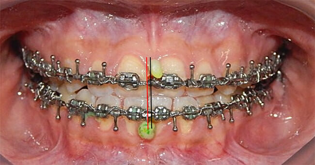 Fig. 14 Intraoral frente progreso