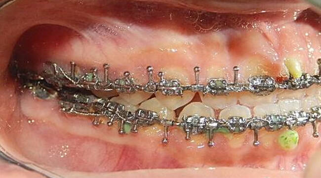 Figura. 15 Intraoral derecha progreso