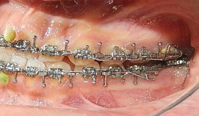 Figura. 16 Intraoral izquierda progreso I