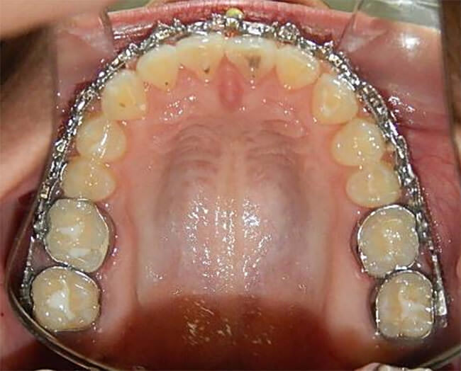 Figura. 17 Oclusal superior progreso I