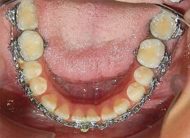 Figura. 18 Oclusal inferor progreso I
