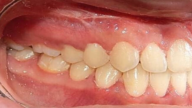 Figura. 25 Intraoral derecha final