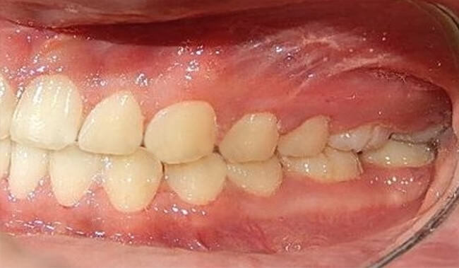 Figura. 26 Intraoral izquierda final