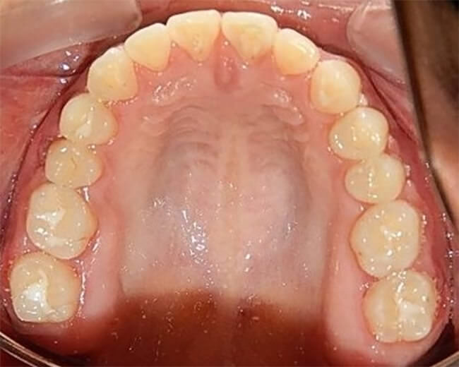 Figura. 27 Oclusal superior final