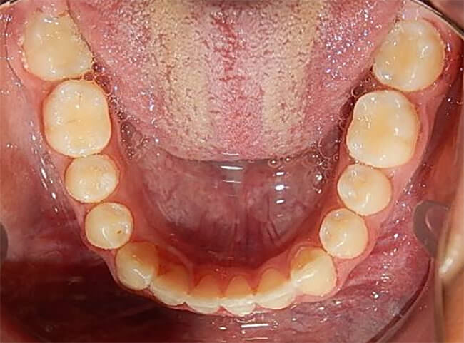 Figura. 28 Oclusal inferior final