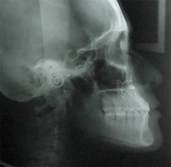 Fig. 29 Rx cefálica lateral final