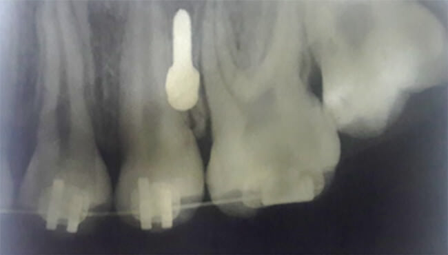 Figura 1 Radiografía donde se observa aproximación radicular