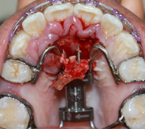 Figura 4 Irritación y sobreinfección de la mucosa