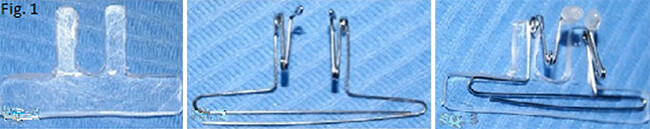 Fig. 1 Fabricación del conformador nasal bilateral.