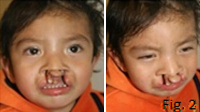 Fig. 2 Paciente con presencia de Labio y Paladar Hendido bilateral. Puede notarse la falta de unión entre los procesos palatinos laterales y la premaxila. (Fotografías cortesía del Dr. José Víctor Avalos Rodríguez)