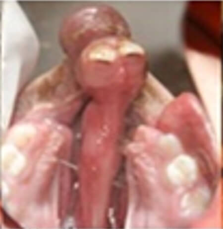 Fig. 3 Paciente con y paladar hendido bilateral. Puede apreciarse la franca proyección de la premaxila.