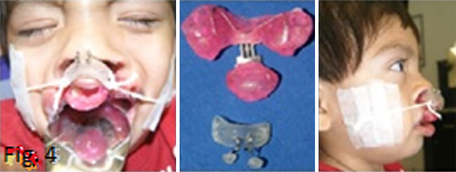Fig. 4 Colocación del conformador nasal bilateral en conjunto con un aparato de retracción