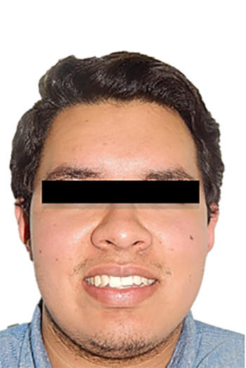 Fig.1 Extraoral frente