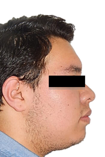 Fig.2 Extraoral de perfil